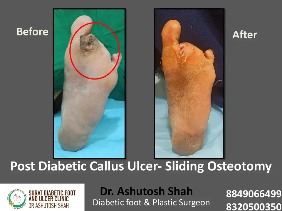 Diabetic Foot  PPT 3 checked by sir.pptx-33.webp